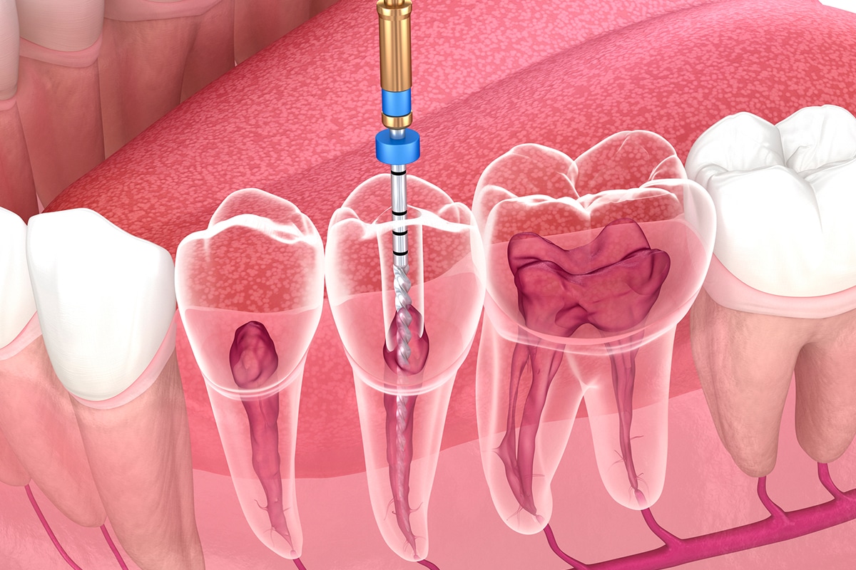 Endodonti