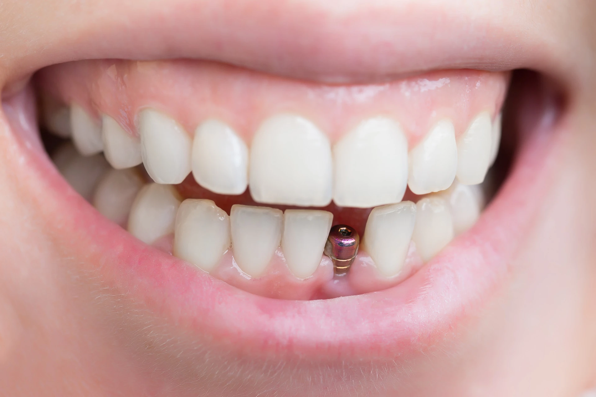 Implante Dentare