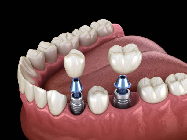 Implante Dentare